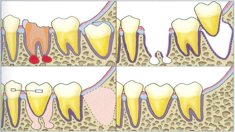 Cấy chuyển răng là gì? Cấy chuyển răng diễn ra như thế nào? 2