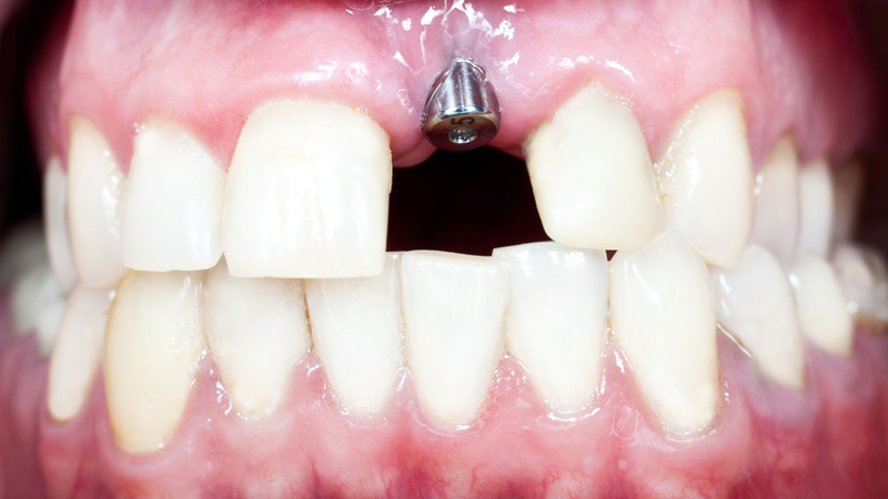 Cấy implant răng cửa là gì? Có đau không và mất bao lâu? 1