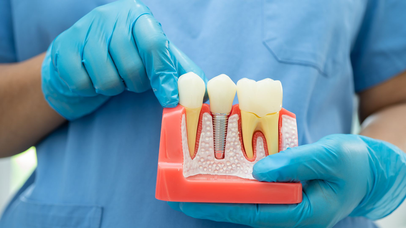 Cấy implant răng cửa là gì? Có đau không và mất bao lâu? 4