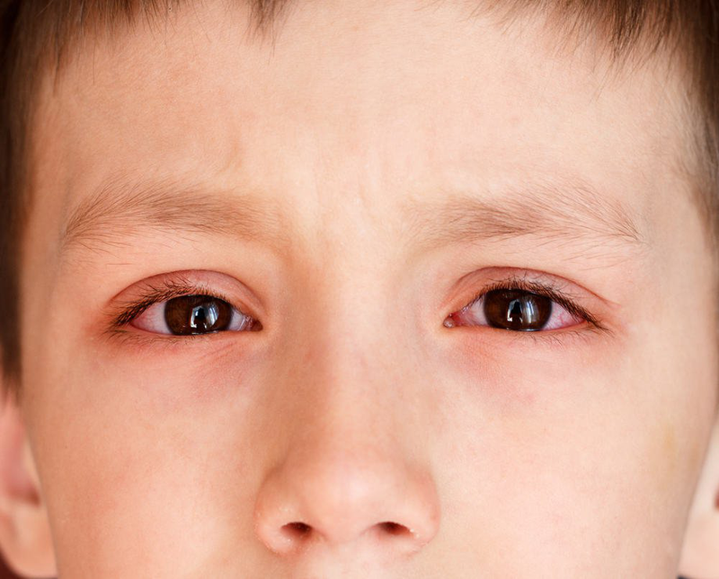 Cha mẹ nên làm gì khi trẻ bị sốt và sưng mắt? 1