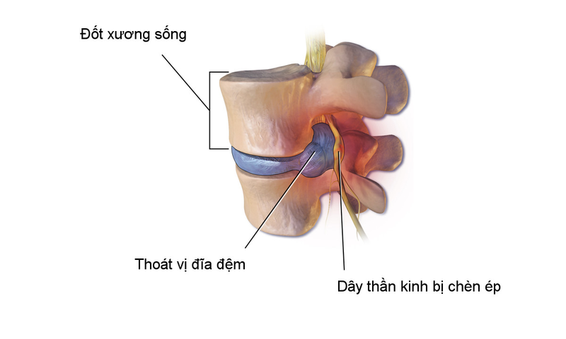 Châm cứu chữa thoát vị đĩa đệm được không? Cần lưu ý những gì? 2