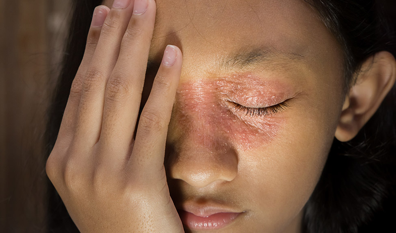 Tìm hiểu về bệnh chàm da mặt: Nguyên nhân, triệu chứng, cách điều trị 2