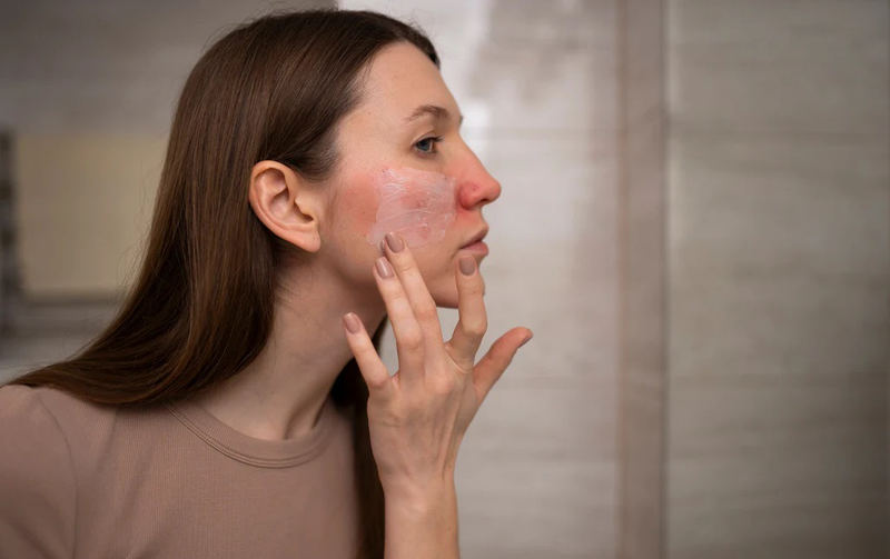 Tìm hiểu về bệnh chàm da mặt: Nguyên nhân, triệu chứng, cách điều trị 4