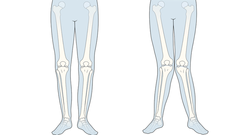 Chân chữ X ở người lớn: Nguyên nhân, triệu chứng và cách điều trị 2