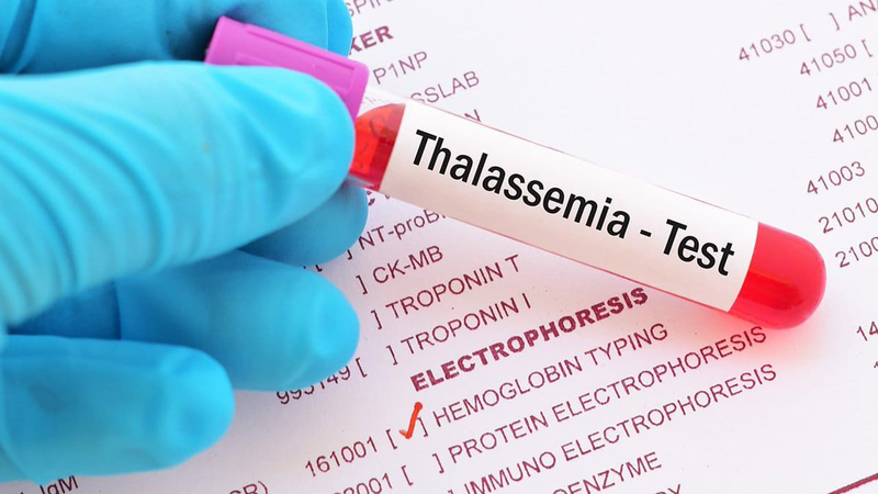 Chẩn đoán và điều trị Thalassemia 2