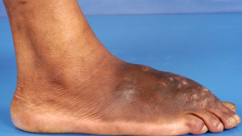 Chân madura là gì? Nguyên nhân, triệu chứng và cách điều trị 4