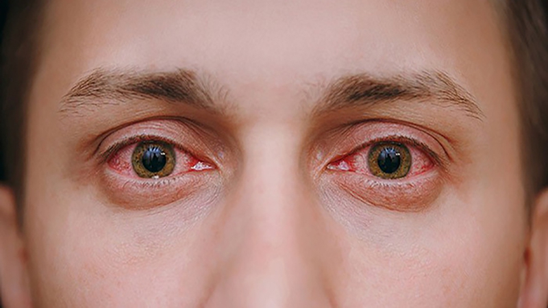 Sử dụng không đúng cách thuốc nhỏ mắt dẫn đến tổn thương giác mạc