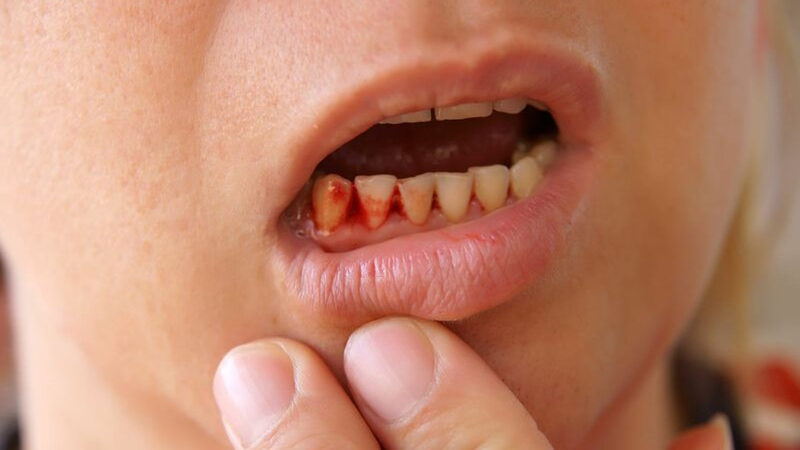 Chảy máu chân răng ung thư cảnh báo bệnh gì? 1