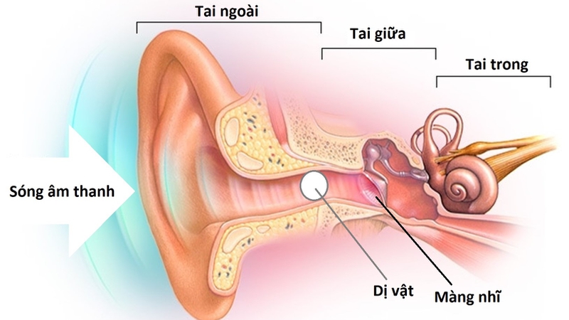 Chảy máu tai: Triệu chứng, nguyên nhân, chẩn đoán, điều trị và cách phòng ngừa 5