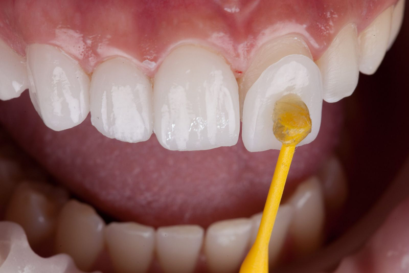 Chi phí bọc răng sứ cho răng hô như thế nào? 2