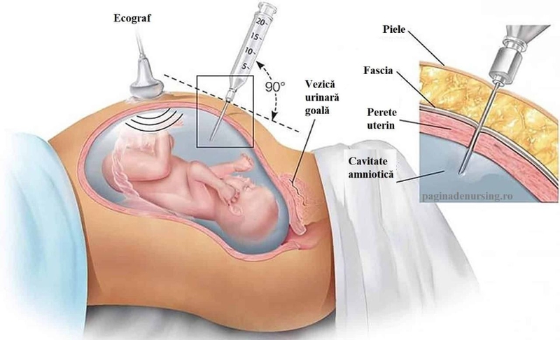 Chi phí chọc ối là bao nhiêu? 1