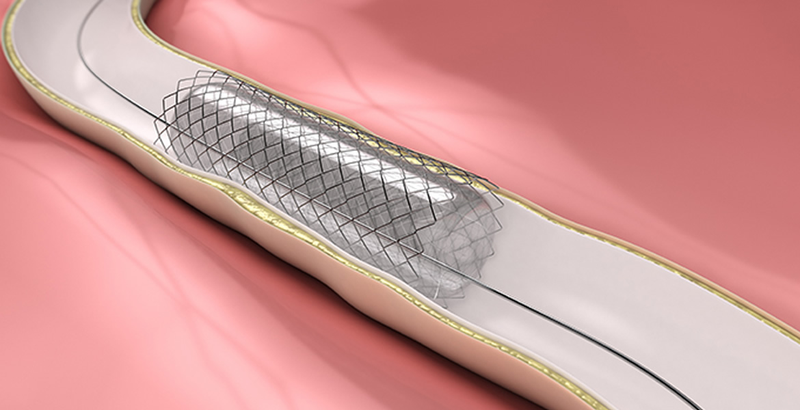 Đặt stent động mạch cảnh là một thủ thuật nhằm mở rộng lòng động mạch cảnh bị hẹp để phòng ngừa hoặc điều trị đột quỵ