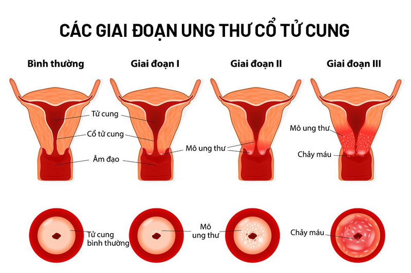 Điều trị ung thư cổ tử cung tốn bao nhiêu tiền?-3