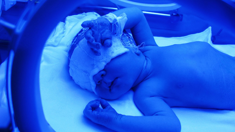 Chỉ số bilirubin bao nhiêu thì phải chiếu đèn?