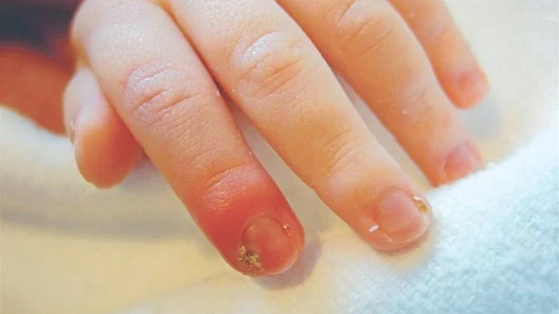 Chín mé ngón tay: Triệu chứng và cách phòng ngừa 2
