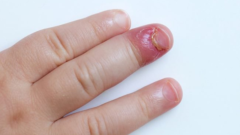 Chín mé ngón tay: Triệu chứng và cách phòng ngừa 4