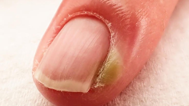 Chín mé ngón tay: Triệu chứng và cách phòng ngừa 1