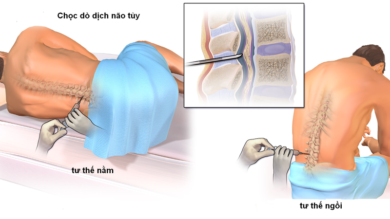 Chọc dò tủy sống có đau không, có ảnh hưởng gì không 2