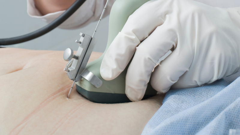 Dưới hướng dẫn trực tiếp bằng siêu âm, bác sĩ dùng kim nhỏ, dài xuyên qua thành bụng và tử cung để vào túi ối