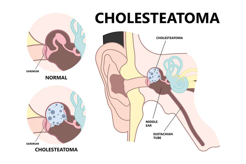 Cholesteatoma bẩm sinh là bệnh gì? Nguyên nhân, triệu chứng, cách điều trị 1
