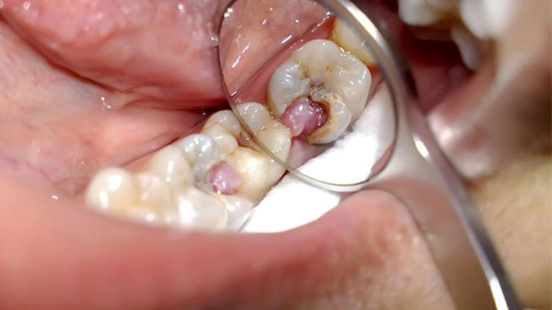 Chữa răng sâu lồi thịt bao nhiêu tiền? Bệnh có nguy hiểm? 1