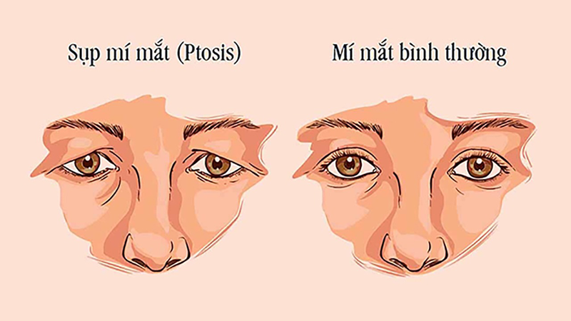 Chữa sụp mí mắt bằng diện chẩn có hiệu quả không? 1