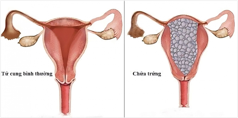 Tìm hiểu về tình trạng chửa trứng bán phần 1