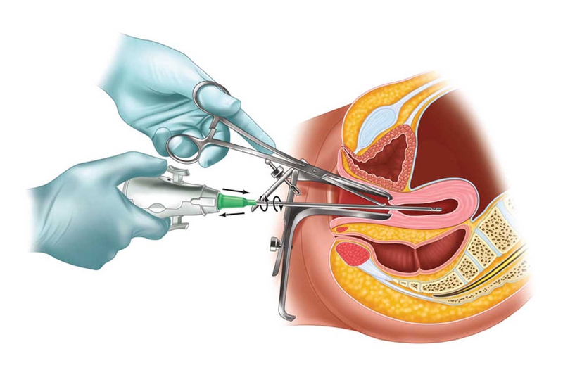 Tìm hiểu về tình trạng chửa trứng bán phần 3