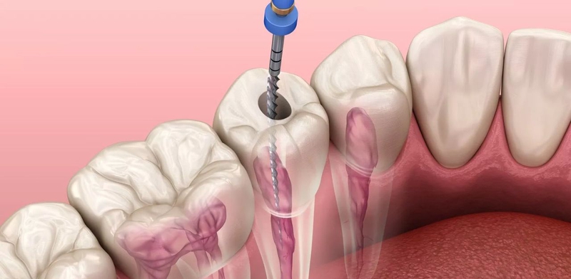 Chữa tủy răng có đau không và ai nên chữa tủy răng? 1