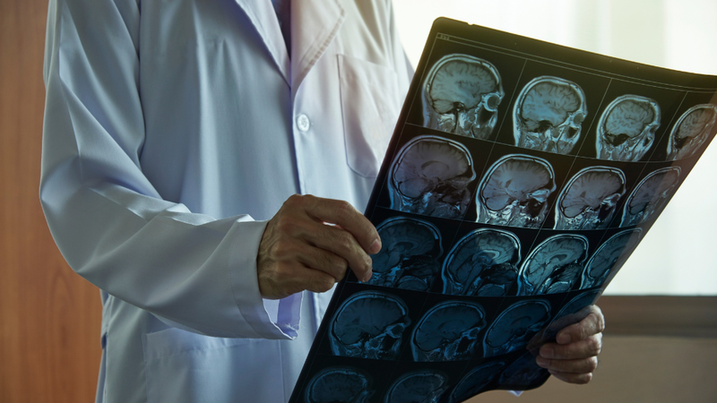 MRI giúp phát hiện sớm và chẩn đoán chính xác nhiều bệnh lý não - thần kinh nghiêm trọng