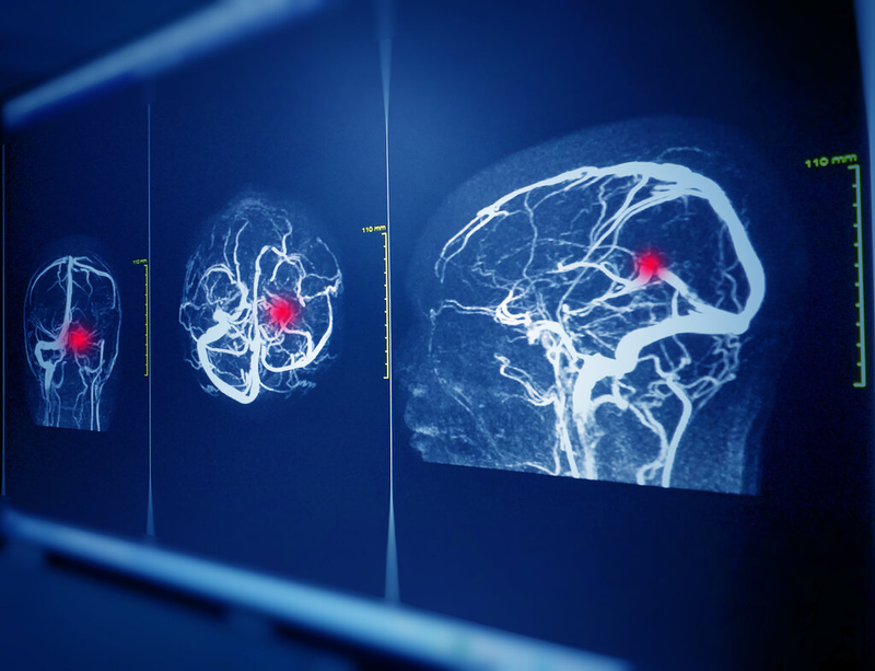 Chụp MRI mạch máu não là gì? Những trường hợp nào chống chỉ định chụp MRI mạch máu não? 1