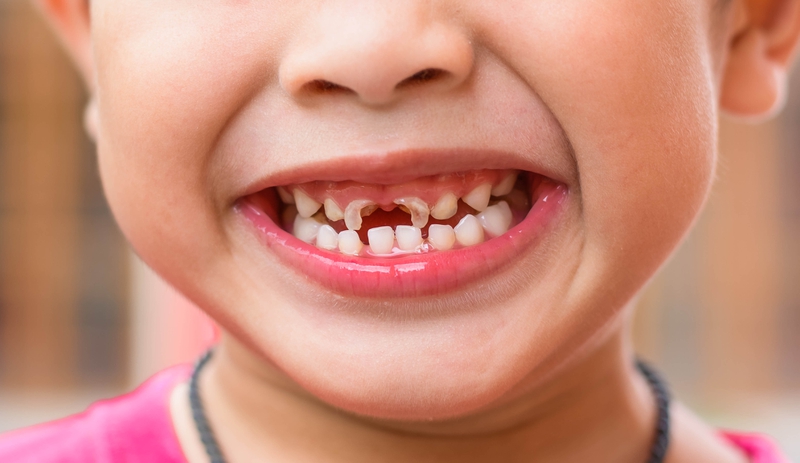 Chụp răng thép cho trẻ và những điều có thể bạn chưa biết 2