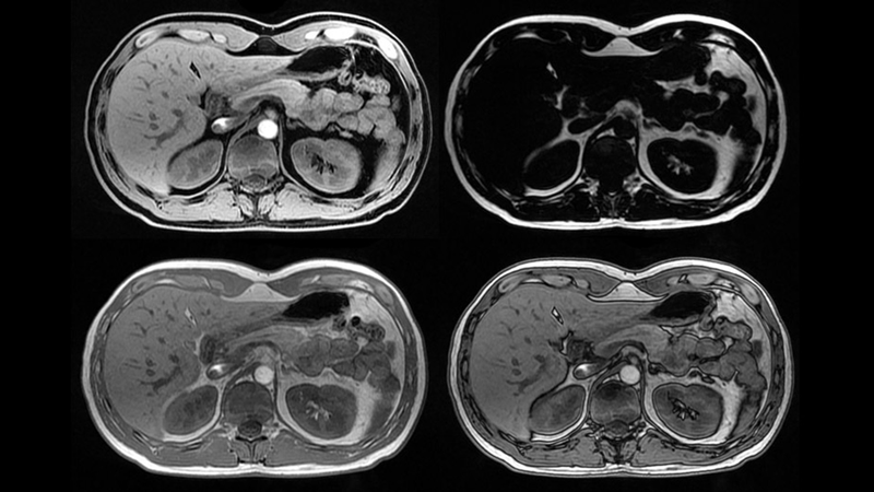 Tìm hiểu chi tiết về phương pháp chụp MRI ngực bụng chậu 1