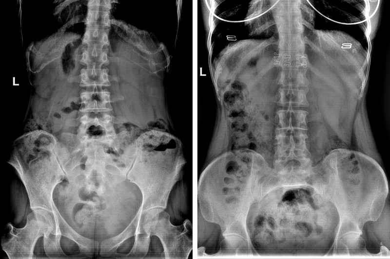 Chụp X quang bụng không chuẩn bị và những điều bạn cần biết 2