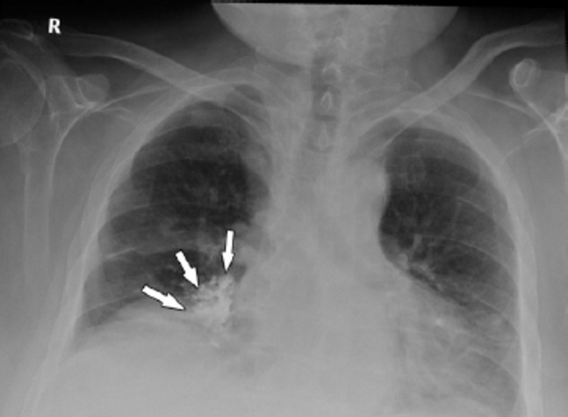 Chụp X quang phổi có vết mờ cảnh báo bệnh gì 1