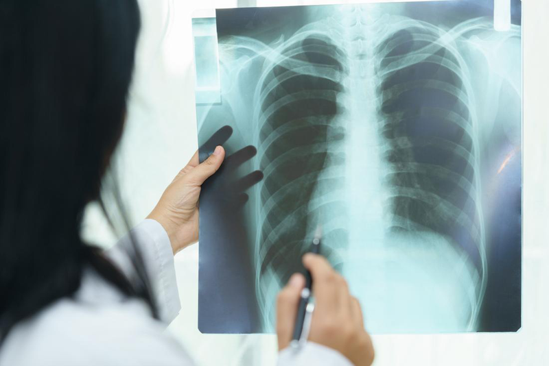 Chụp X quang phổi có vết mờ cảnh báo bệnh gì 2