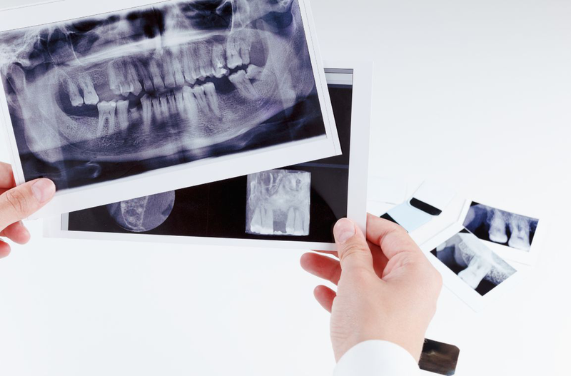 Giúp bạn tìm hiểu về chụp X quang răng toàn cảnh 1