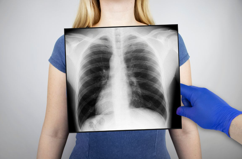 Tìm hiểu chi tiết về kỹ thuật chụp X quang tim phổi 1
