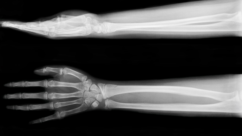 Chụp X-quang xương cẳng tay thẳng nghiêng là kỹ thuật gì? Chỉ định và quy trình 1