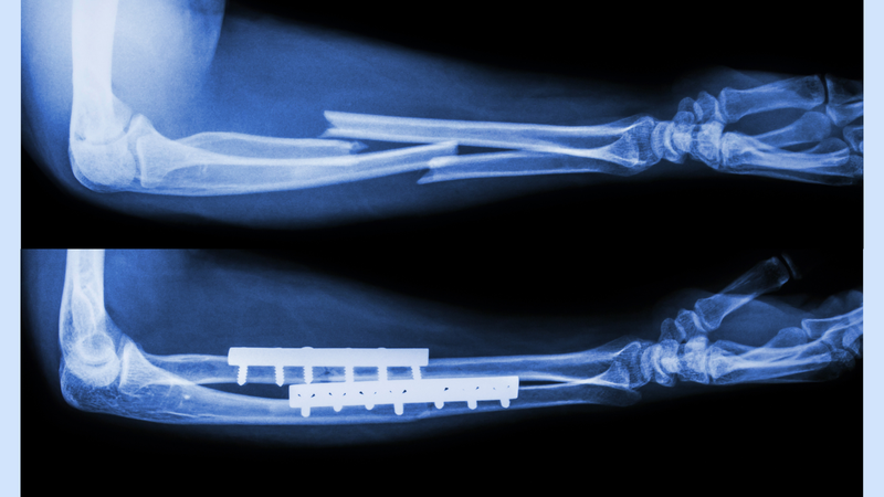 Chụp X-quang xương cẳng tay thẳng nghiêng là kỹ thuật gì? Chỉ định và quy trình 2