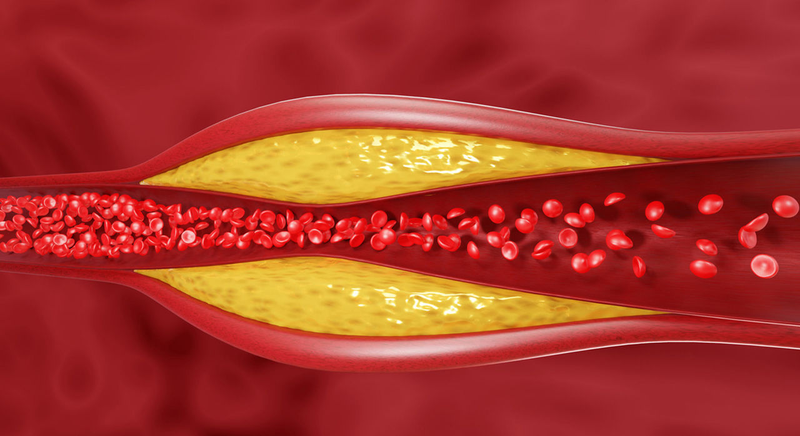 Chuyển hóa lipid: Nguyên nhân, triệu chứng và cách điều trị 