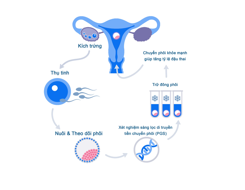 Chuyển phôi là gì? Quy trình chuyển phôi vào tử cung trong IFV 3