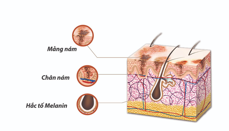 Hiểu hơn về cơ chế hình thành nám để điều trị, ngăn ngừa nám hiệu quả 2