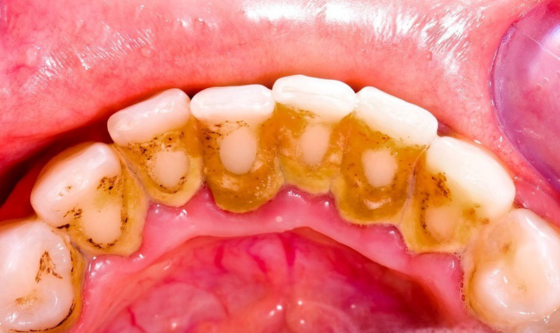 Có nên áp dụng cách làm rụng cao răng tại nhà? 1