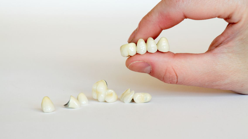Có nên bọc răng sứ không​? Ưu và nhược điểm bạn cần biết 1