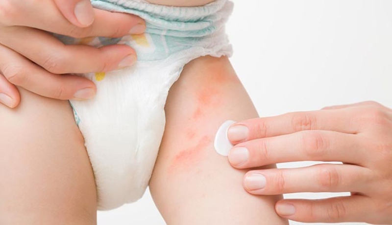 Có nên đóng bỉm 24/24 cho trẻ sơ sinh? Những lưu ý khi đóng bỉm cho bé 1