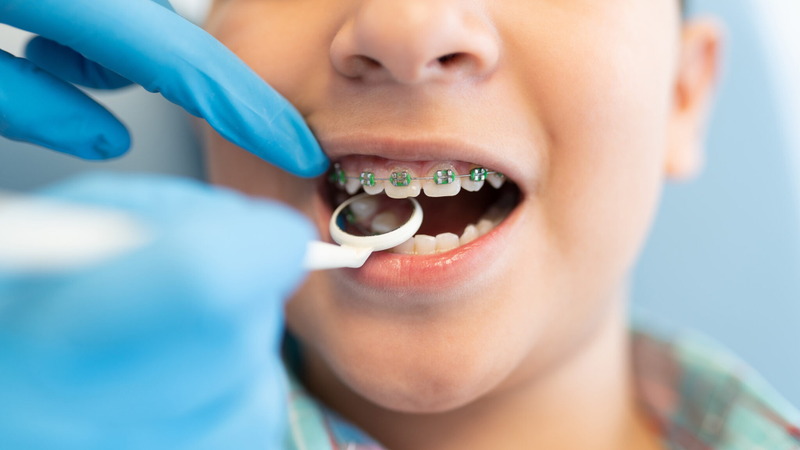 Có nên niềng răng cho trẻ 9 tuổi? Độ tuổi nào phù hợp niềng răng 4