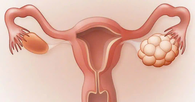 Có nên uống oresol khi bị quá kích buồng trứng không? Khi nào nên uống oresol 1