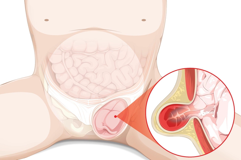 Có thể chữa thoát vị bẹn bằng thuốc không?-1