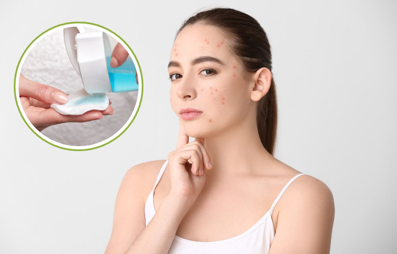 Da bị mụn có nên dùng toner không? Tư vấn từ chuyên gia 1